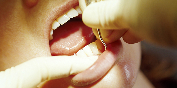 歯周病は早期発見・早期治療が大切です