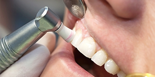 虫歯や歯周病は治療よりも予防が大切です